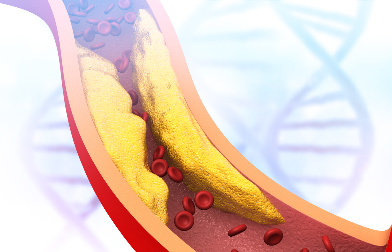 Cholesterol and Ischaemic Stroke Risk
